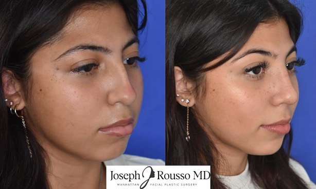Instagram post by Dr. Joseph J. Rousso: A wonderful #rhinoplasty result on a wonderful young patient, just a couple of weeks after surgery.. open rhinoplasty approach to smoothen t…