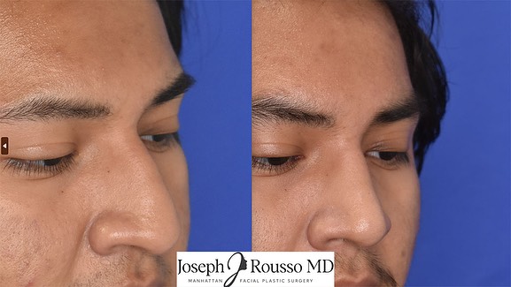 Instagram post by Dr. Joseph J. Rousso: #eachnoseisunique We never strive to make all noses look the same! *every patient is unique *every patient has their own goals, preferences …