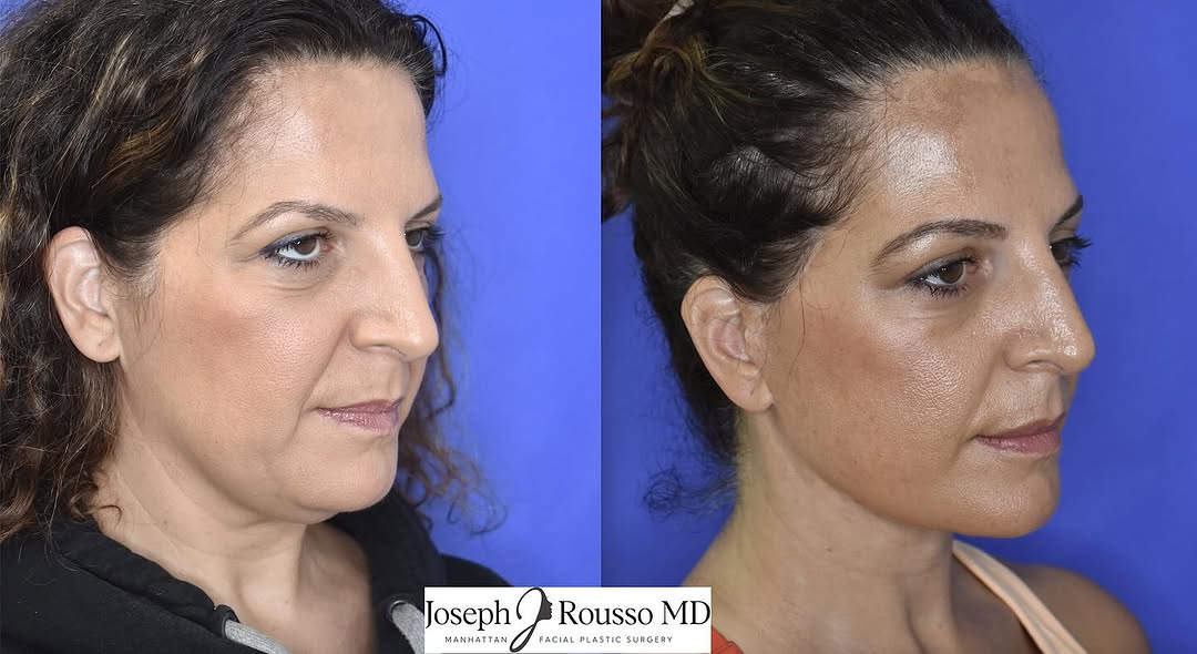 Instagram post by Dr. Joseph J. Rousso: Just a lovely patient that we were so excited to see with a fresh and natural appearance!! Before and 8 months after deep plane face and nec…