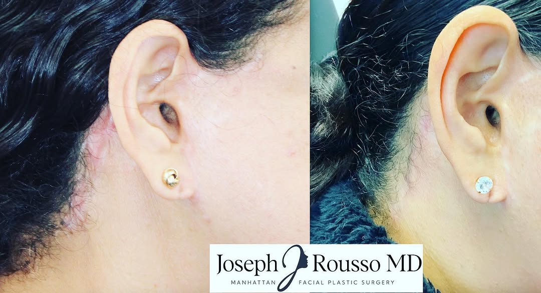 Instagram post by Dr. Joseph J. Rousso: What is this post all about ??? It’s about explaining one of many facelift and necklift complications that can occur from poor technique. Th…