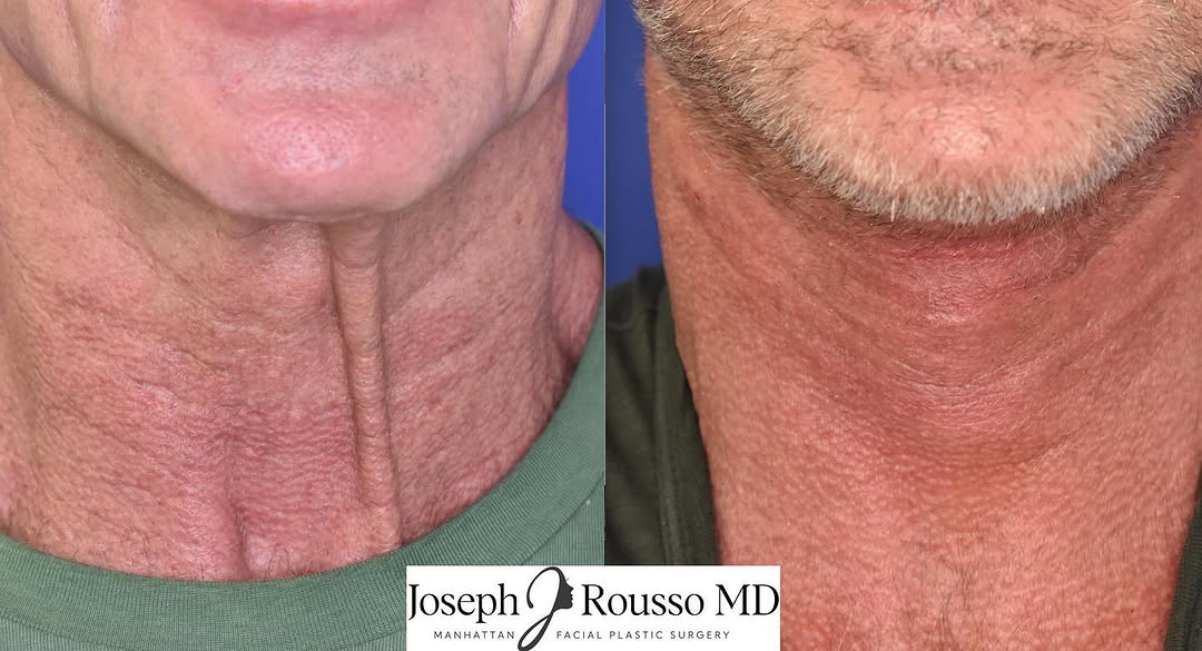 Instagram post by Dr. Joseph J. Rousso: Male face and neck rejuvenation. This wonderful patient wanted a smoother neck without prominent bands. Before and after #deepplanefacelift …