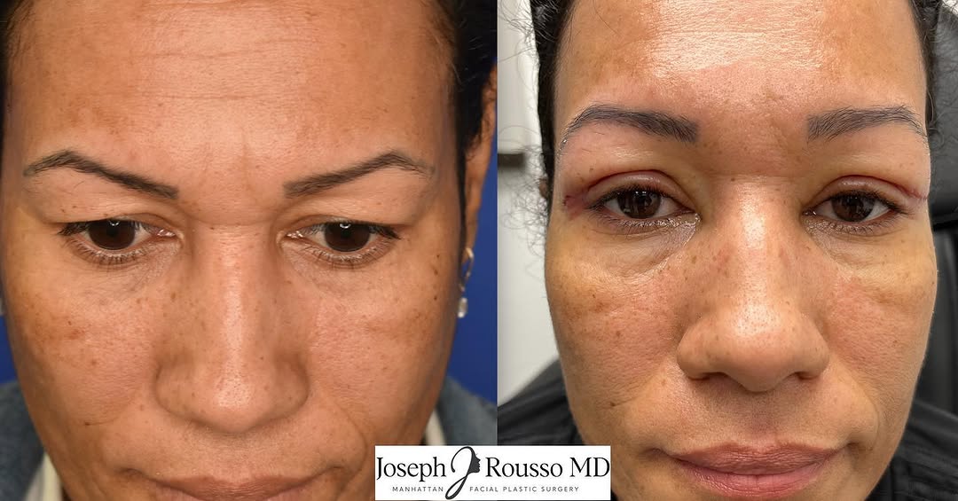 Instagram post by Dr. Joseph J. Rousso: One of the best surgeries to help soften and create #rejuvenatedeyelids is an in-office upper eyelid #blepharoplasty. This procedure has min…