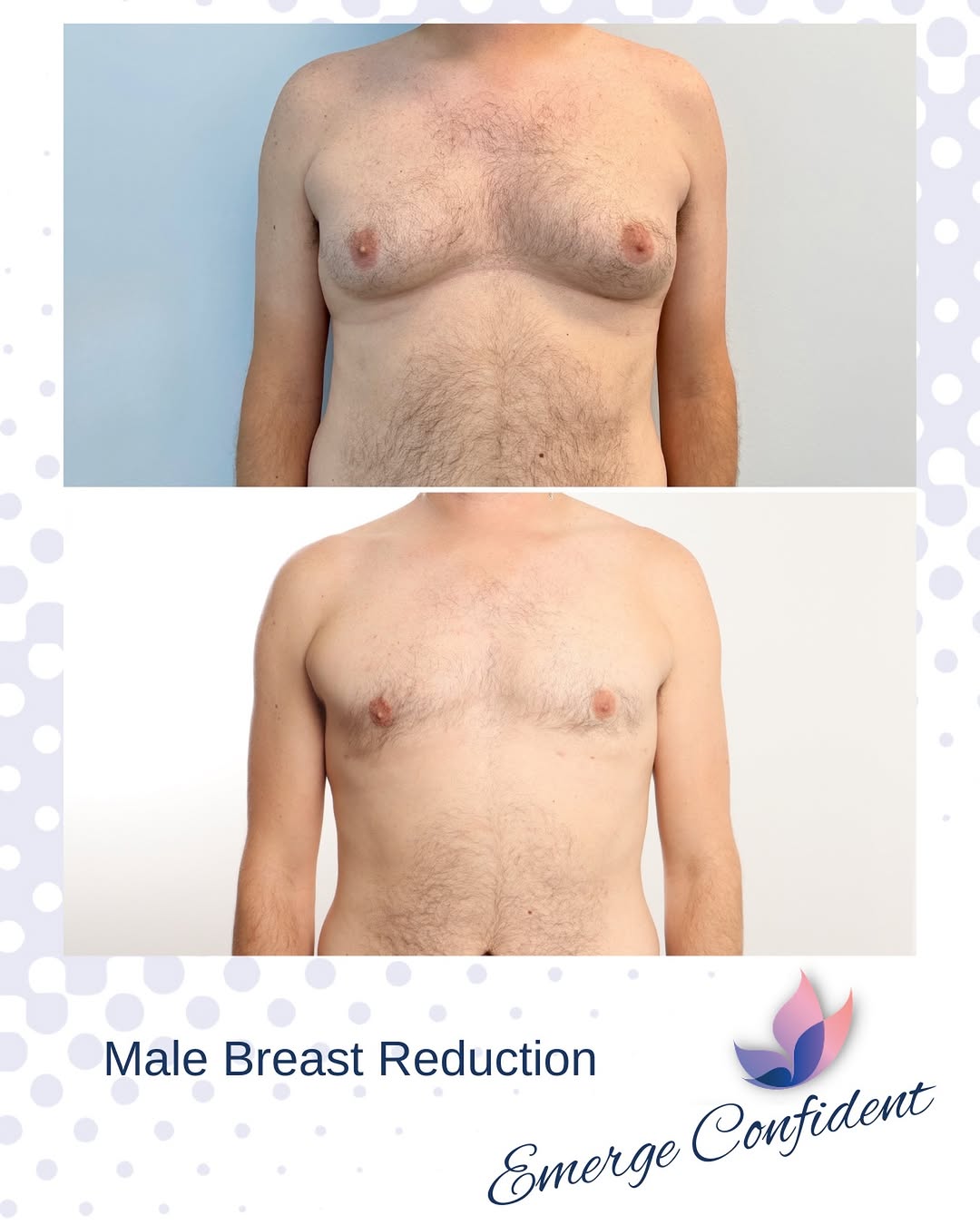 Instagram post by Dr. Joseph L. Hill Jr.: A procedure we don’t talk about enough: gynecomastia surgery. 🦋 Dr. Hill’s patient underwent a gynecomastia, also known as male breast redu…
