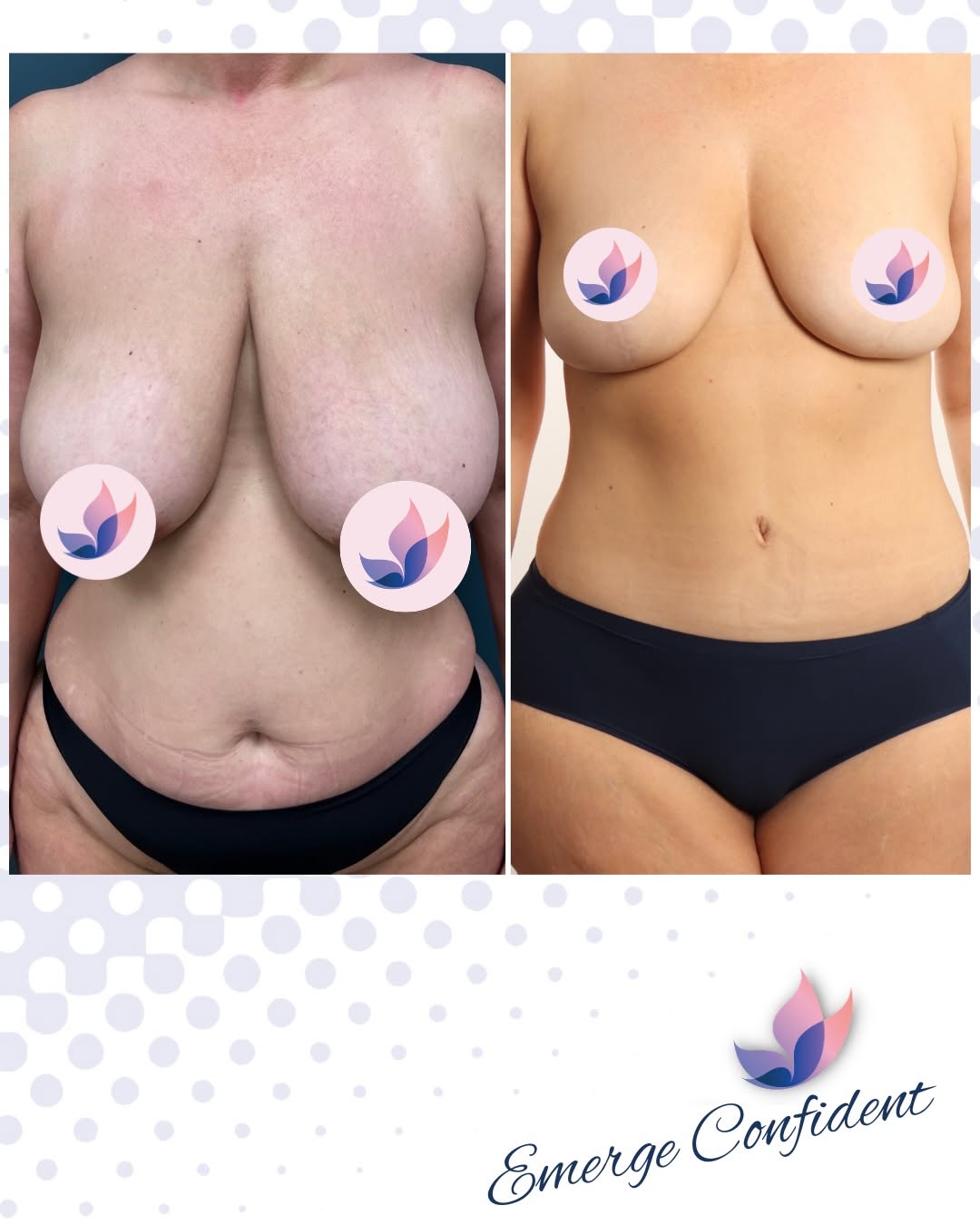 Instagram post by Dr. Joseph L. Hill Jr.: Three procedures. One beautifully balanced result. 🦋 Dr. Lynch’s patient underwent an arm lift, lower body lift and breast lift to address …
