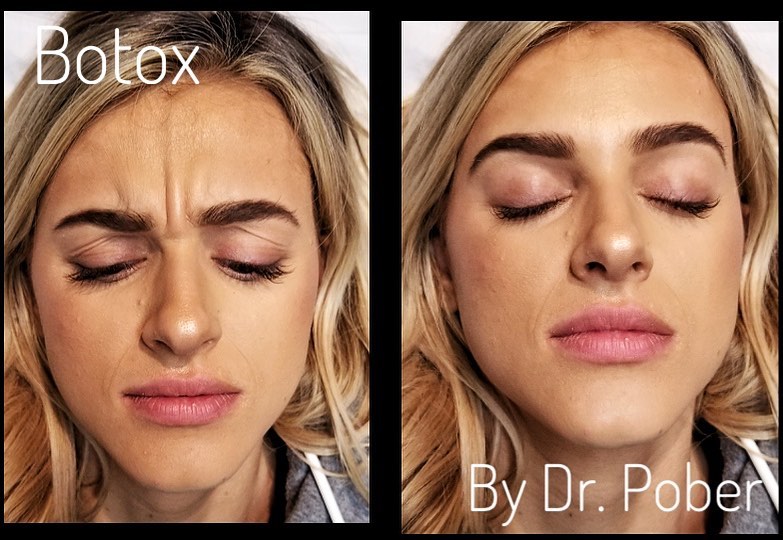 Instagram post by Dr. Joseph M. Pober: Men and women with moderate to severe frown lines may benefit from using Botox. Wrinkles and frown lines are not just limited to aging; take…