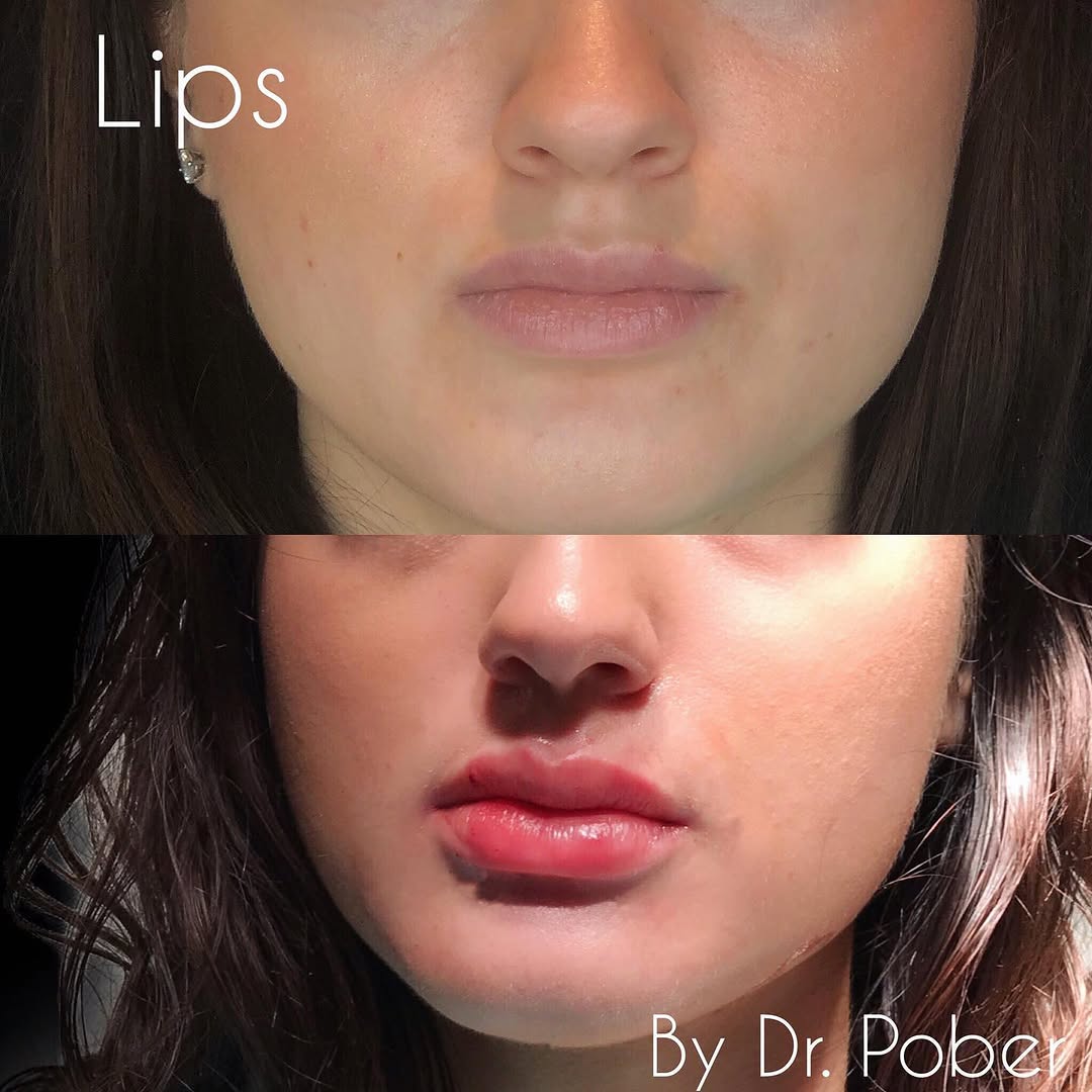 Instagram post by Dr. Joseph M. Pober: Pucker up 👄 ! Lip enhancement using lip fillers by the one and only Dr. Pober. We are obsessed with the shape! 😍 gorgeous lips are a perfe…