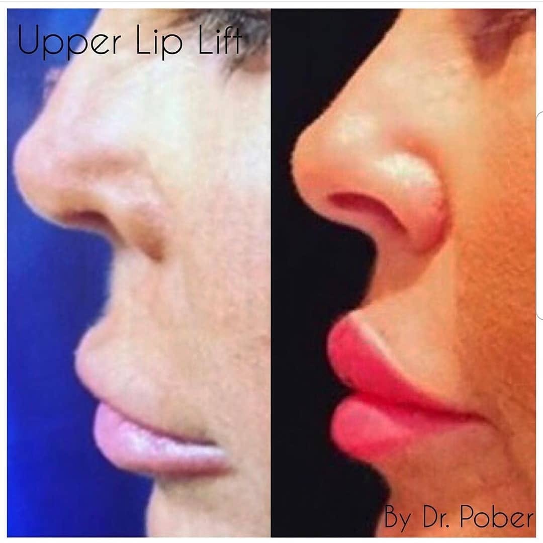 Instagram post by Dr. Joseph M. Pober: Sometimes a little more is better! We're happy about these 💋 Lip lift using the Gullwing Technique! #lipinjections #lip #plasticsurgery #po…