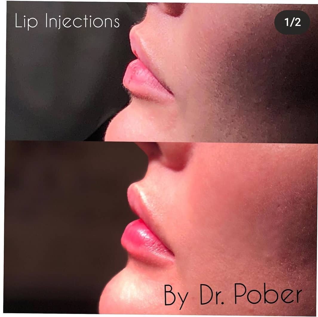 Instagram post by Dr. Joseph M. Pober: This patient has relied on us to keep her lips looking PLUMP and GORGEOUS for over 5 YEARS. What makes her come back? RESULTS. #lipfillers #…