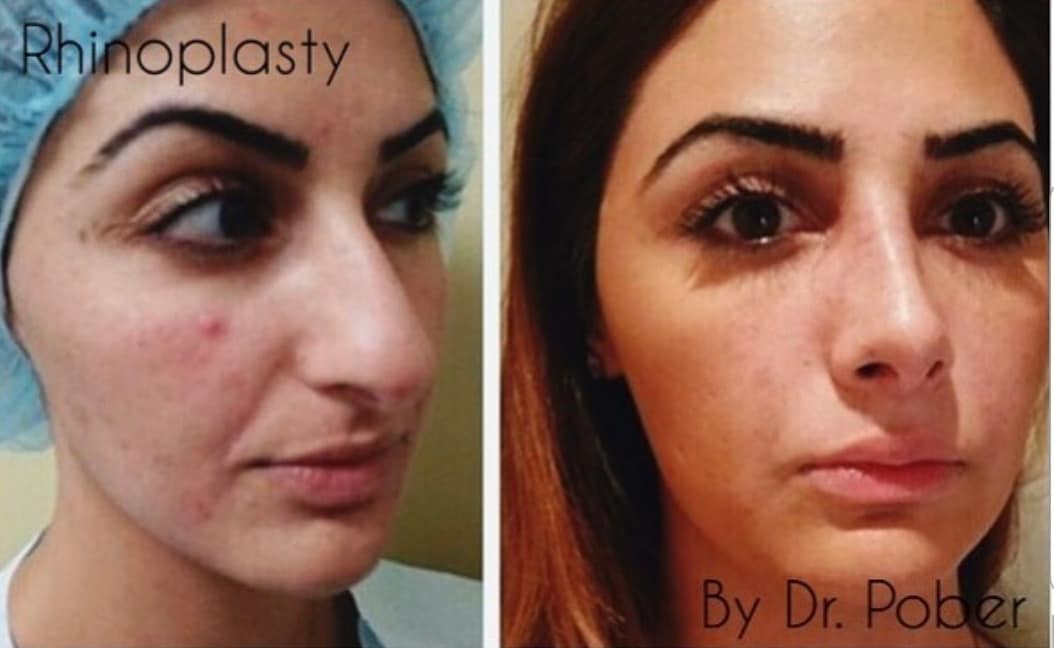 Instagram post by Dr. Joseph M. Pober: Rhinoplasty done by Dr. Pober! Come book yours today by sending us a message or calling our office: 201-652-4515! #rhinoplasty #nosejob #dre…
