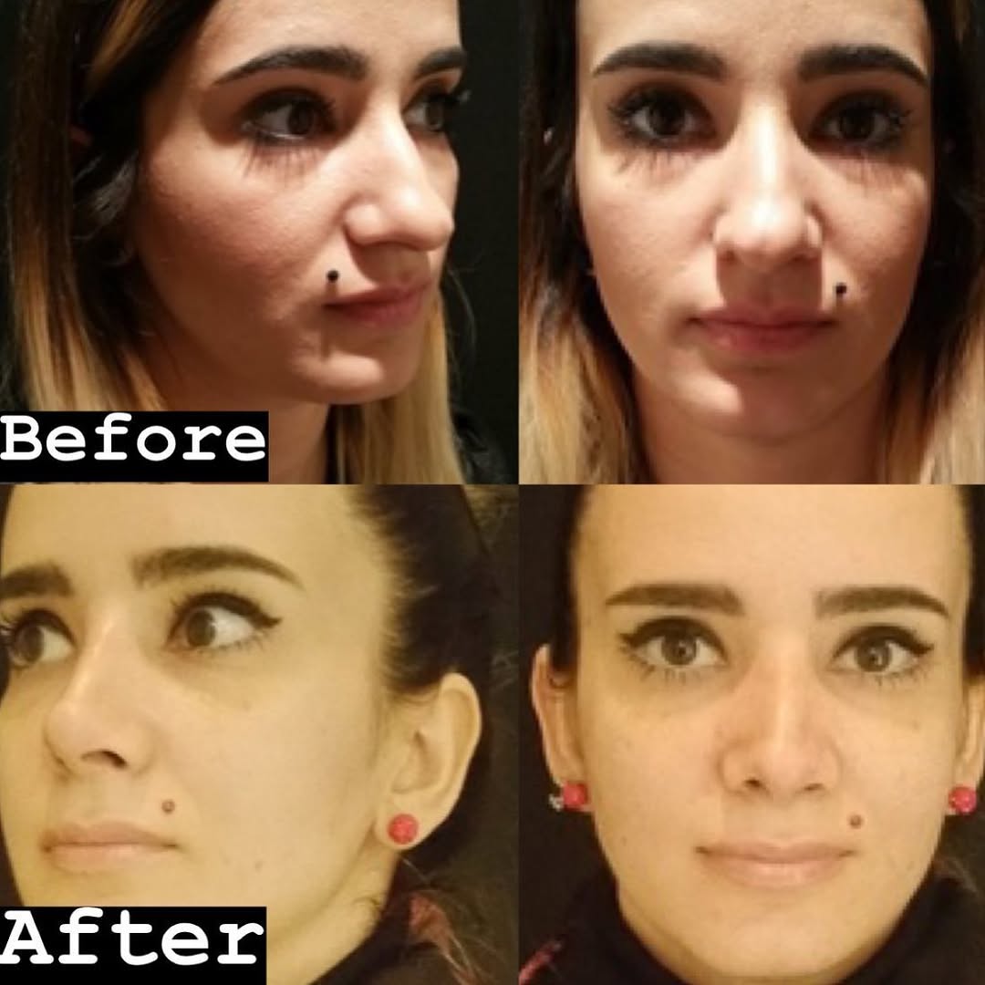 Instagram post by Dr. Joseph M. Pober: Miss us? Here are some terrific before and afters. @25_magazine called Dr.Pober the King Of Rhinoplasty for a good reason. Check out this am…