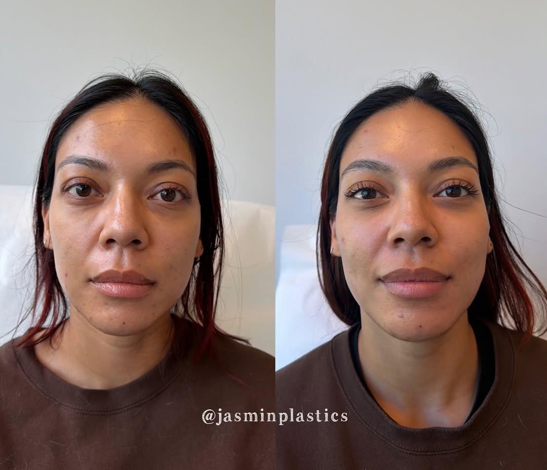 Instagram post by Dr. Joseph Mardanzai: 2 months after her first Sculptra treatment ✨ Sculptra works by stimulating your body’s own collagen production, which gradually restores vo…