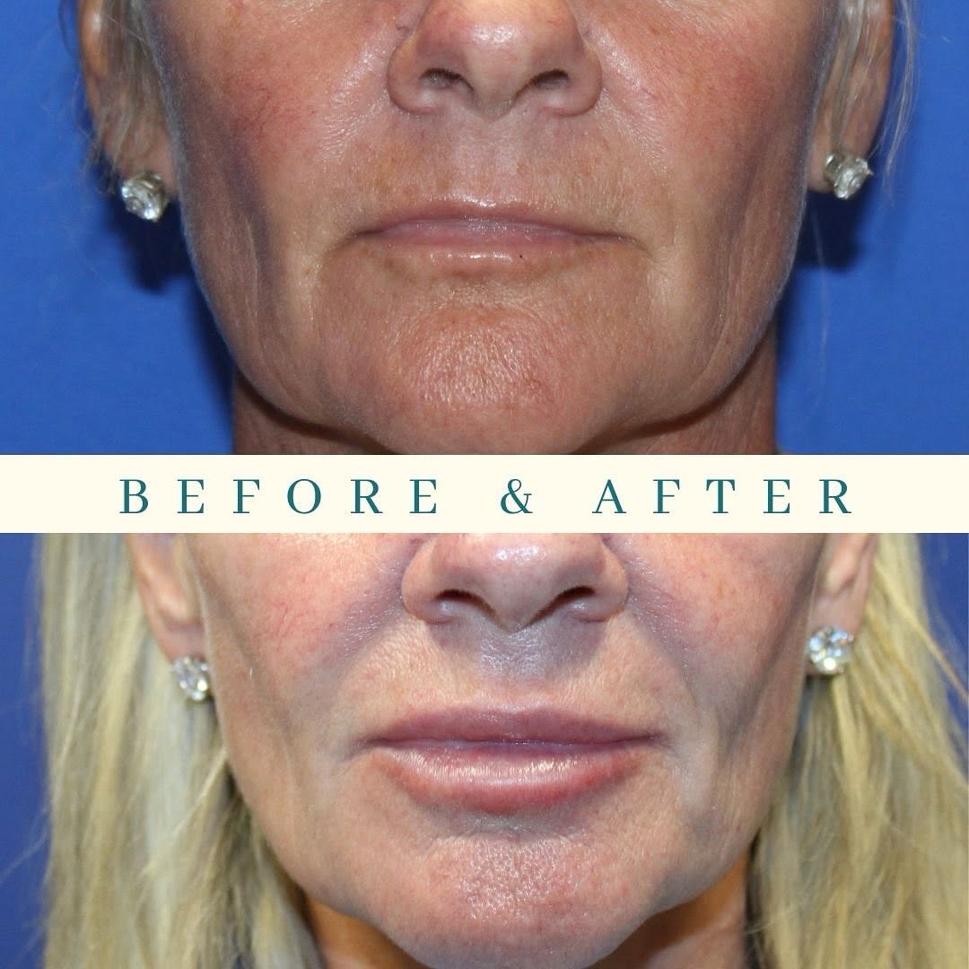 Instagram post by Dr. Joseph P. Lupo: 💋 Lips that speak volumes. Injector-Leah Trahan, NP 📍Plastic & Reconstructive Surgery of Acadiana 900 E. St. Mary Blvd., Suite 104 Lafayet…