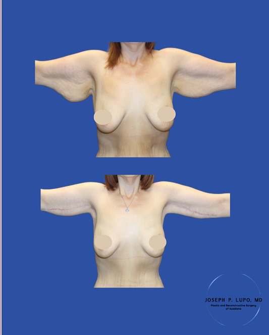 Instagram post by Dr. Joseph P. Lupo: Benefits of a Brachioplasty: 💪🏻 •Improved arm contour and definition • Reduced excess hanging skin • Better fit in clothing • Increased co…