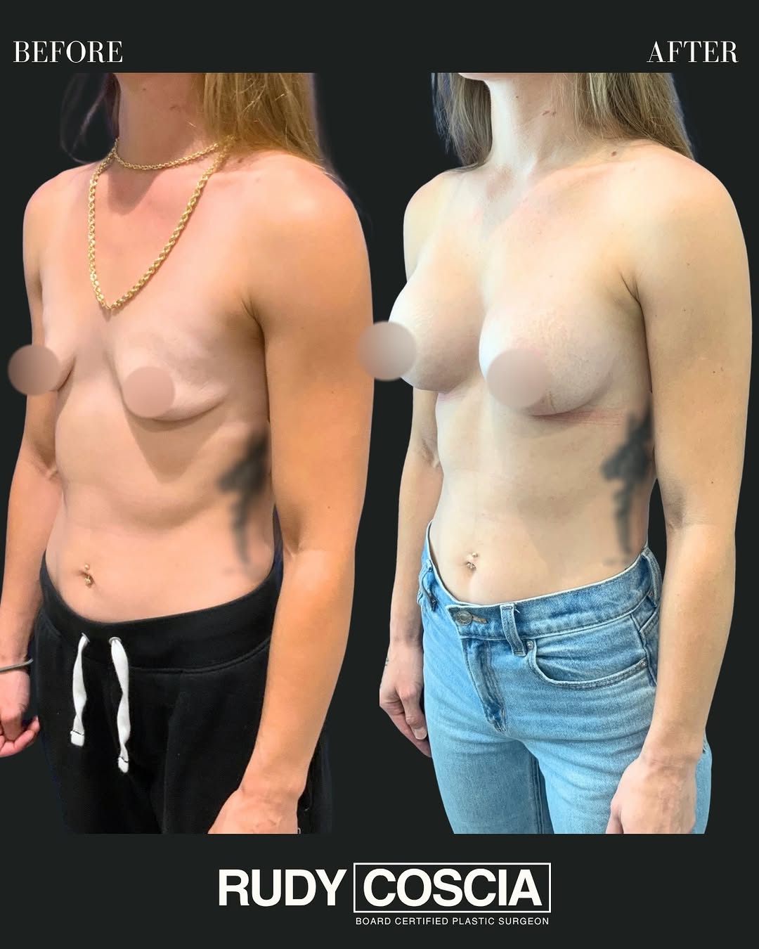 Instagram post by Dr. Joseph R. Coscia: This patient underwent a breast augmentation with 325cc silicone gel implants to enhance volume while also improving some slight pre-existin…