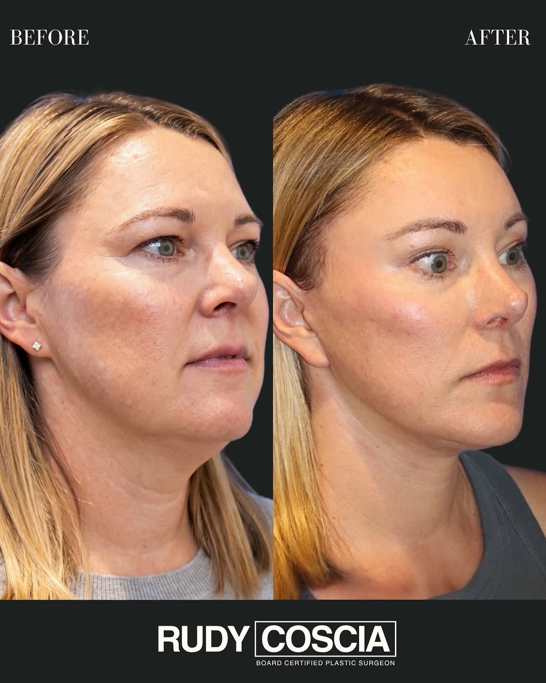 Instagram post by Dr. Joseph R. Coscia: In her mid-40s, this patient was beginning to experience early to moderate facial and neck aging, including softening through the jawline an…