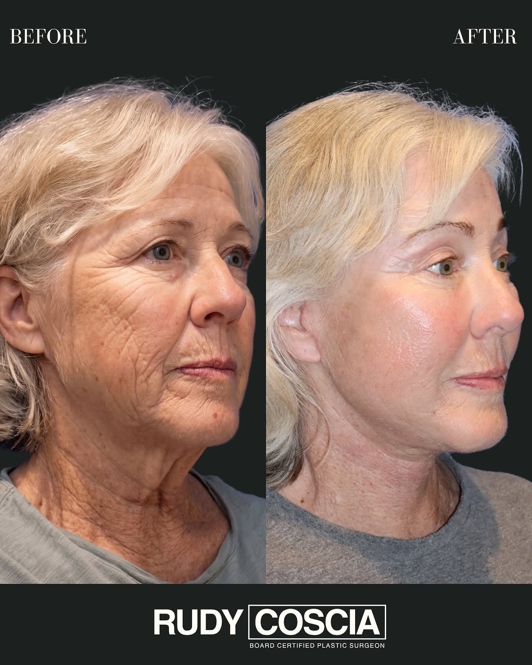 Instagram post by Dr. Joseph R. Coscia: Facial aging isn’t caused by skin alone. As we age, we lose facial volume, tissues descend, and skin elasticity changes. That’s why addressi…