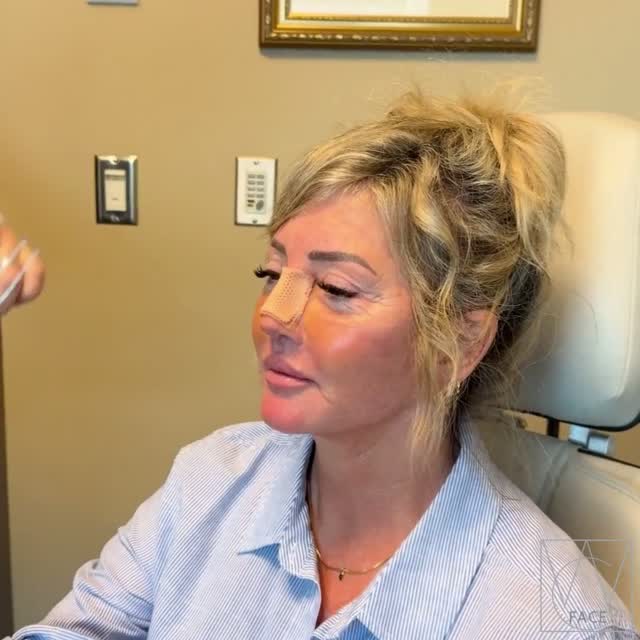Instagram post by Dr. Joseph Shvidler: "I am so happy. Very feminine." . #westcoastface #seattlefacial #rhinoplasty #rhinoplastybeforeandafter #rhinoplastyreveal . . Dr. Joseph Sh…