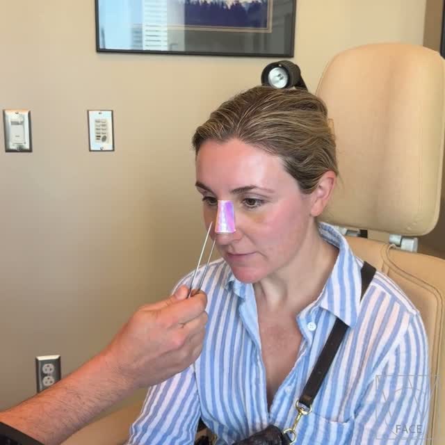 Instagram post by Dr. Joseph Shvidler: For years, this beautiful patient felt like she was fighting for every breath. Severe nasal obstruction made exercise difficult, disrupted h…