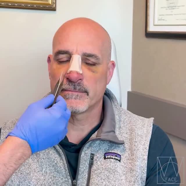 Instagram post by Dr. Joseph Shvidler: A past nasal fracture left this patient with a deviated septum, crooked nasal bones, and chronic difficulty breathing through his nose. Freq…