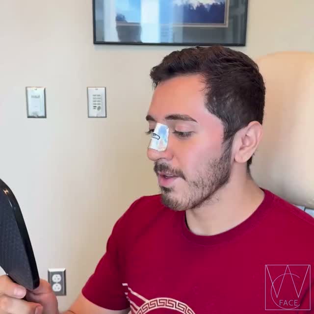 Instagram post by Dr. Joseph Shvidler: This patient wanted to improve his breathing while creating a more balanced, harmonious profile. His goals included lowering the nasal bridg…