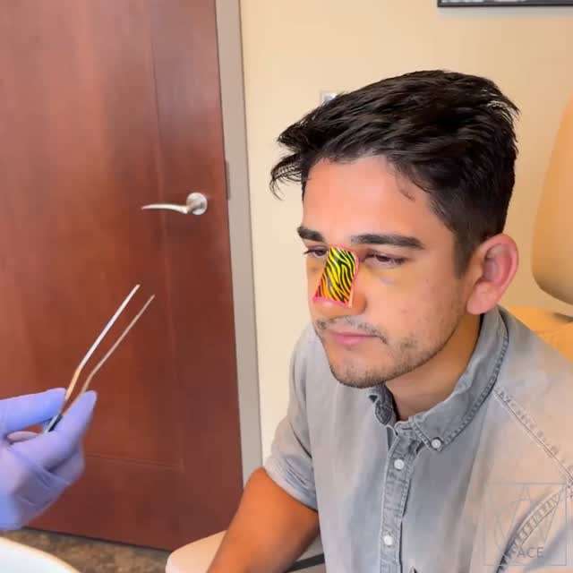 Instagram post by Dr. Joseph Shvidler: Straighter and no more ridge ✅ . . #westcoastface #seattlefacial #rhinoplastybeforeandafter #beforeandafter #rhinoplasty #rhinoplastyspecial…