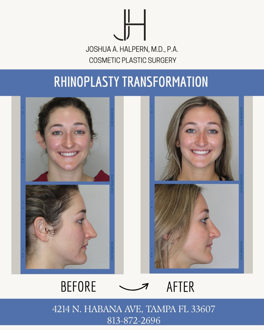 Instagram post by Dr. Joshua A. Halpern: ✨ RHINOPLASTY TRANSFORMATION ✨ A beautiful example of how rhinoplasty can create a more balanced, refined profile while maintaining the pati…
