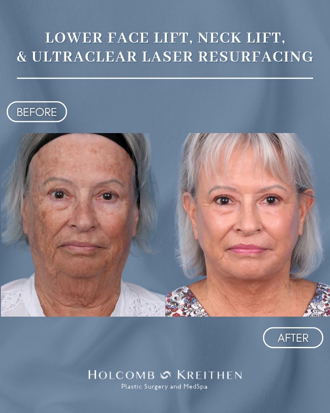 Instagram post by Dr. Joshua Kreithen: A more defined, youthful appearance. 💫 This beautiful patient in her 70's wanted to address jowling, loss of jawline definition, and neck s…