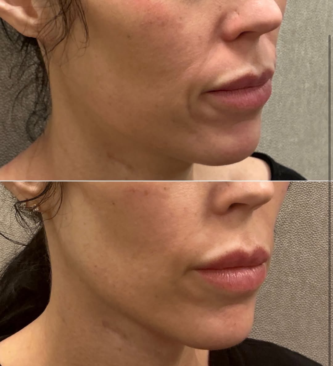 Instagram post by Dr. Joshua Weitz: ✨Filler Friday✨ This 38-year-old female had concerns about skin laxity around her mouth area after weight loss. We did one session of Sculpt…