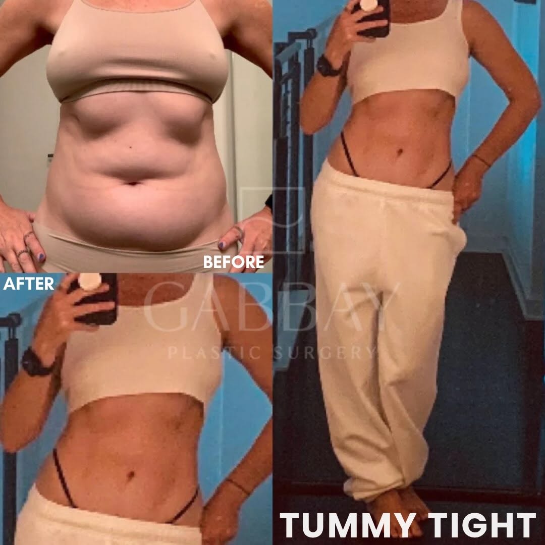 Instagram post by Dr. Joubin Gabbay: TUMMY TIGHT. Not every tummy tuck needs to be the same. This patient wanted a skin-only tuck, focused on removing excess skin and creating a…