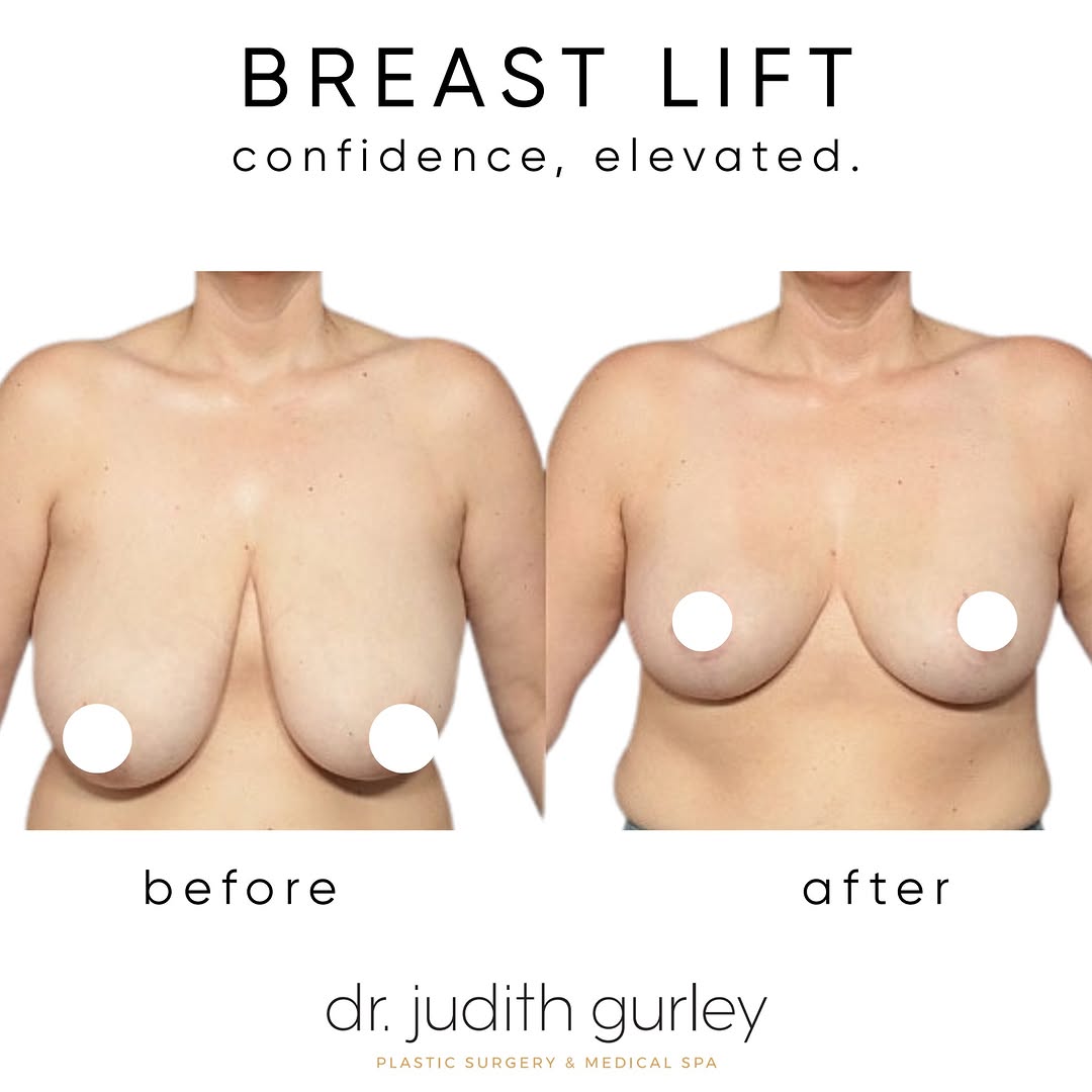 Instagram post by Dr. Judith M. Gurley: With weight loss, pregnancy, and age, natural breast tissue can fall and rest on the upper abdomen. It’s uncomfortable, sweaty, and unflatte…