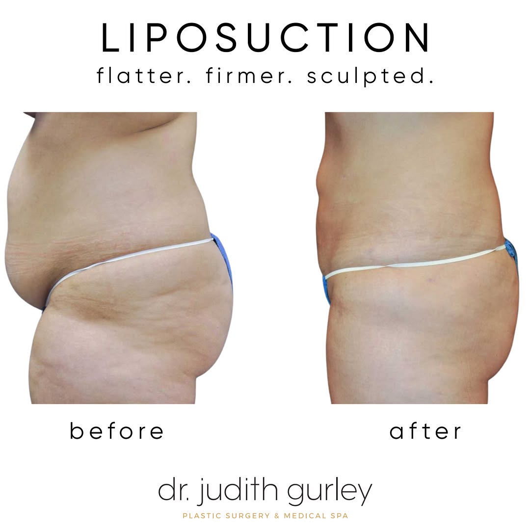 Instagram post by Dr. Judith M. Gurley: Liposuction can refine areas that even a tummy tuck can’t address. If your midsection bothers you, a consultation with a board‑certified pla…