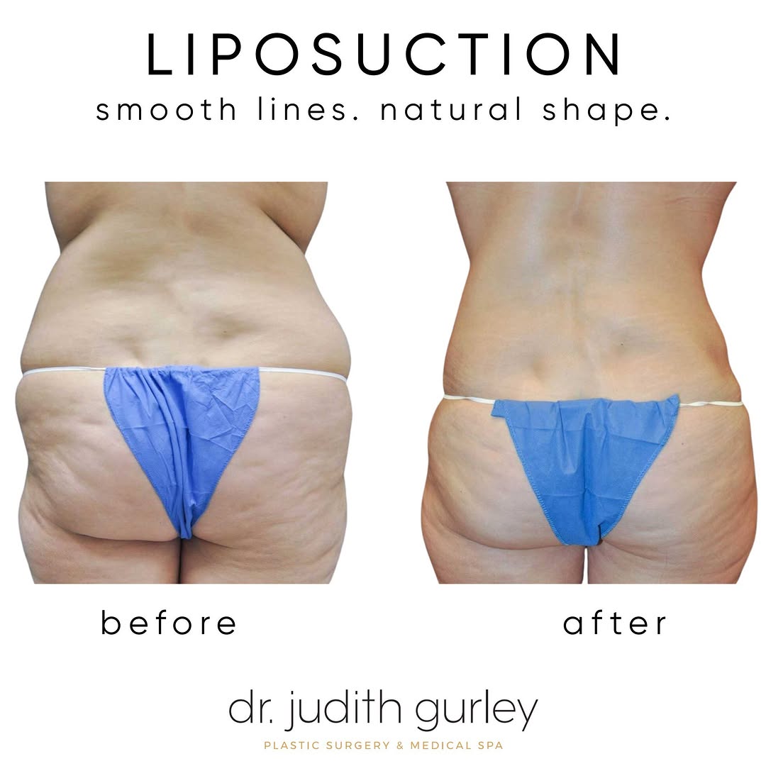 Instagram post by Dr. Judith M. Gurley: I’ve always said that liposuction is powerful! The reason being, liposuction sucks out the fat instantly and permanently from exactly where …