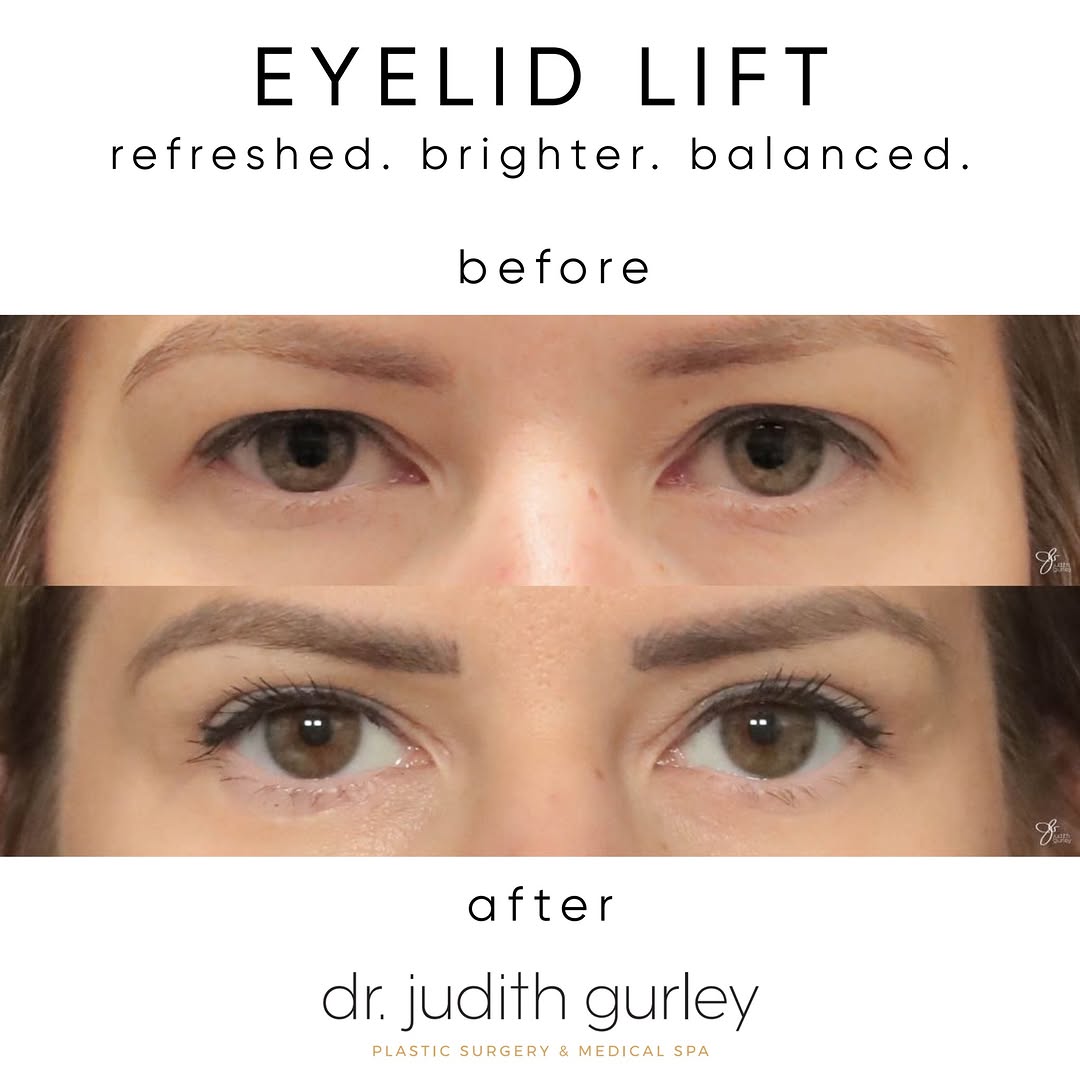 Instagram post by Dr. Judith M. Gurley: Age is not always a factor in needing an upper eyelid lift, or blepharoplasty. Your genetics may dictate excess upper eyelid skin. This exce…