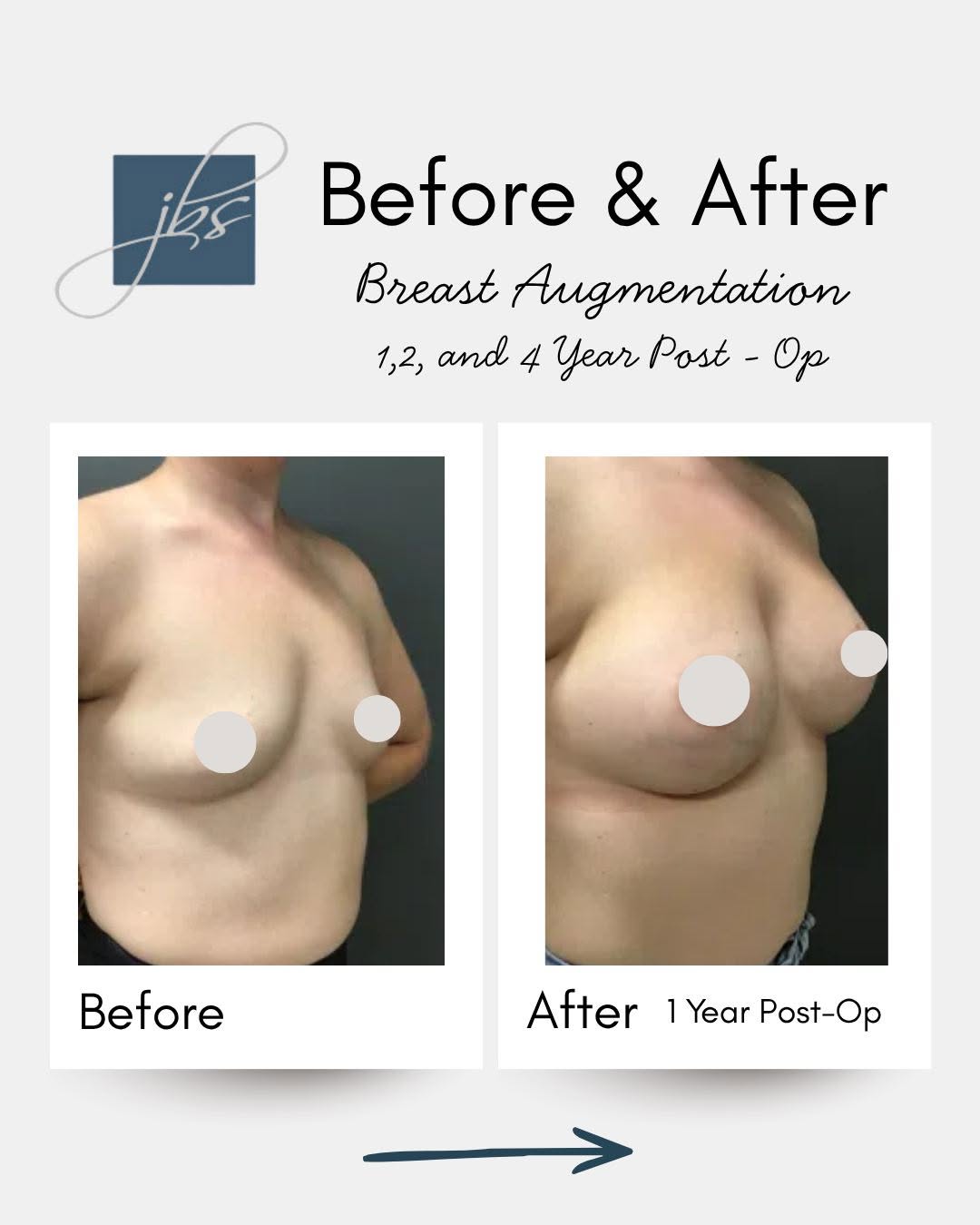 Instagram post by Dr. Julene Samuels: One of the most rewarding parts of breast augmentation is seeing results that continue to look beautiful and natural over time. These before…