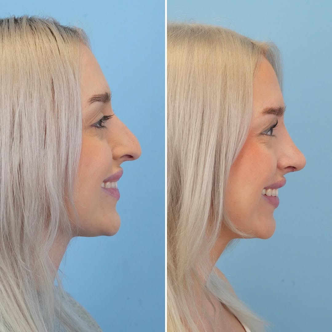 Instagram post by Dr. Julie Shtraks: Love this patient’s early result just 3 weeks after her #rhinoplasty !! ⠀⠀⠀⠀⠀⠀⠀⠀⠀ To see me as a patient for rhinoplasty consultation: ☎️(61…