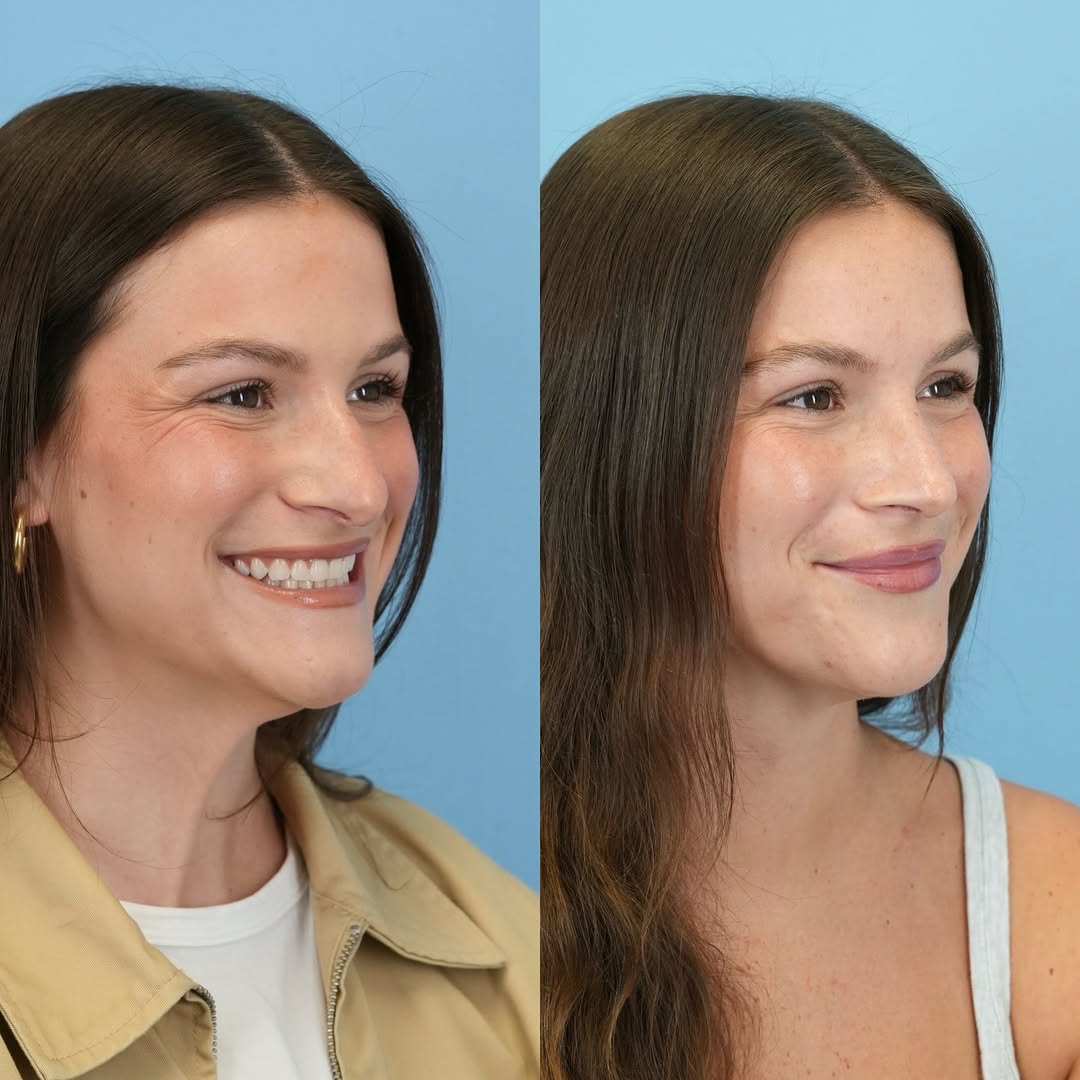 Instagram post by Dr. Julie Shtraks: 3 months post septorhinoplasty ✨softer, refined, elegant and *most importantly* still looking like herself!!