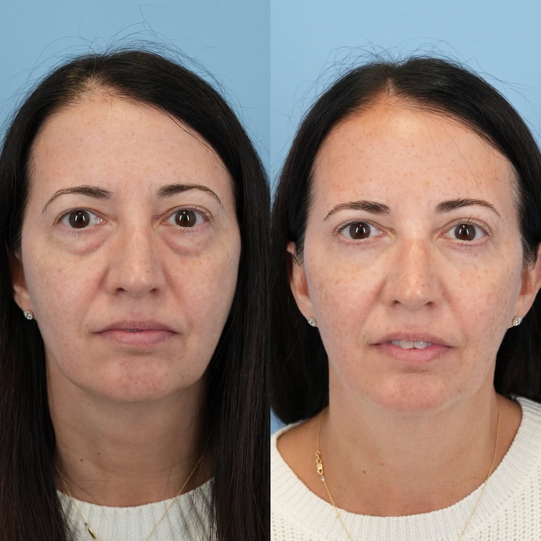 Instagram post by Dr. Julie Shtraks: Before & 3 months post upper and lower blepharoplasty with fat transfer!