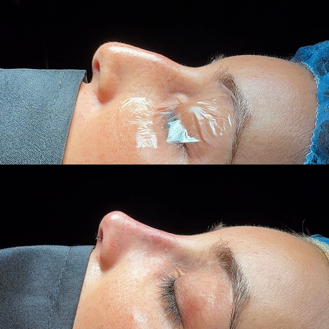 Instagram post by Dr. Julie Shtraks: Before & immediately after #rhinoplasty 🤌🏻