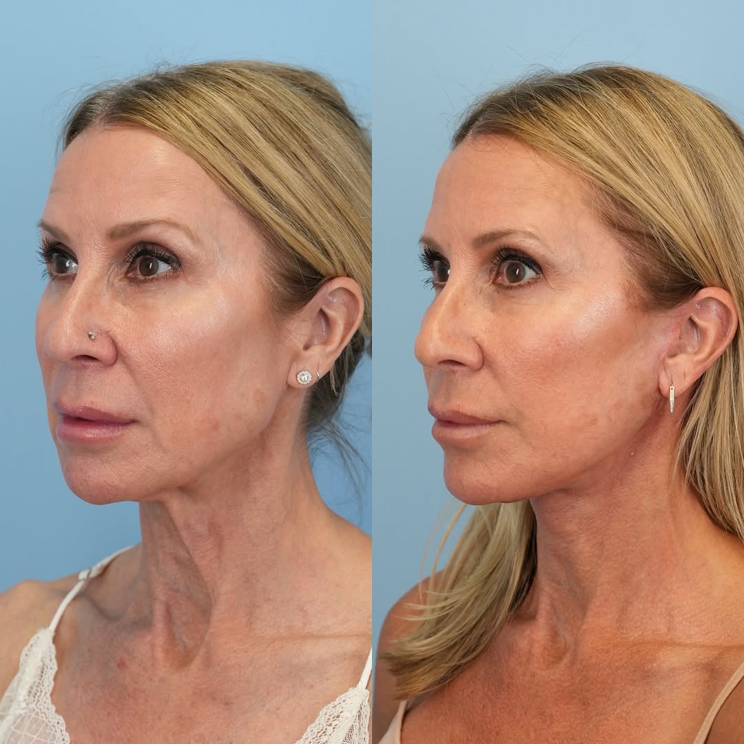 Instagram post by Dr. Julie Shtraks: 2 months post deep plane face and neck lift with fat transfer looking amazing and refreshed ✨