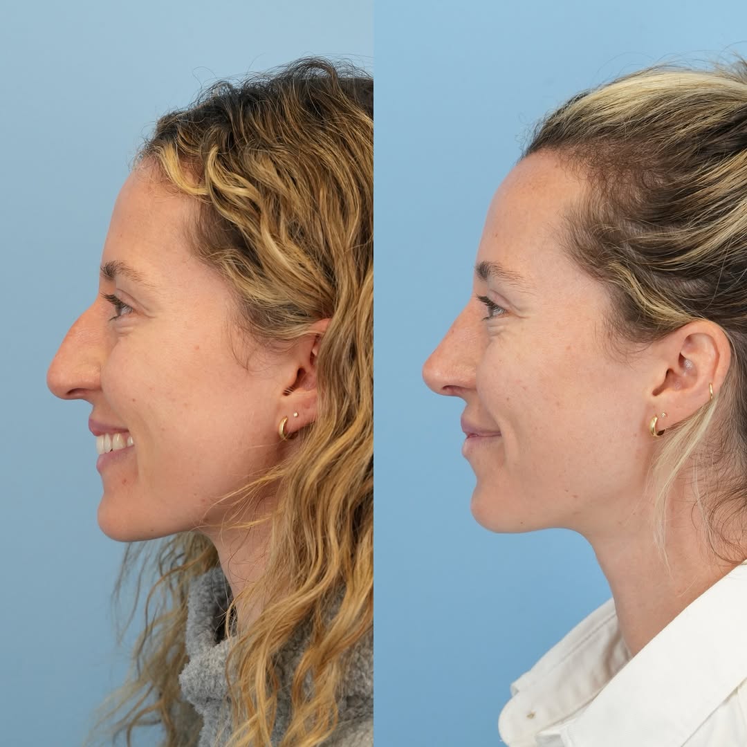 Instagram post by Dr. Julie Shtraks: Before & 3 months after septorhinoplasty ✨ the goal was for natural refinement and to keep her looking like herself, and we achieved it!! 🪄