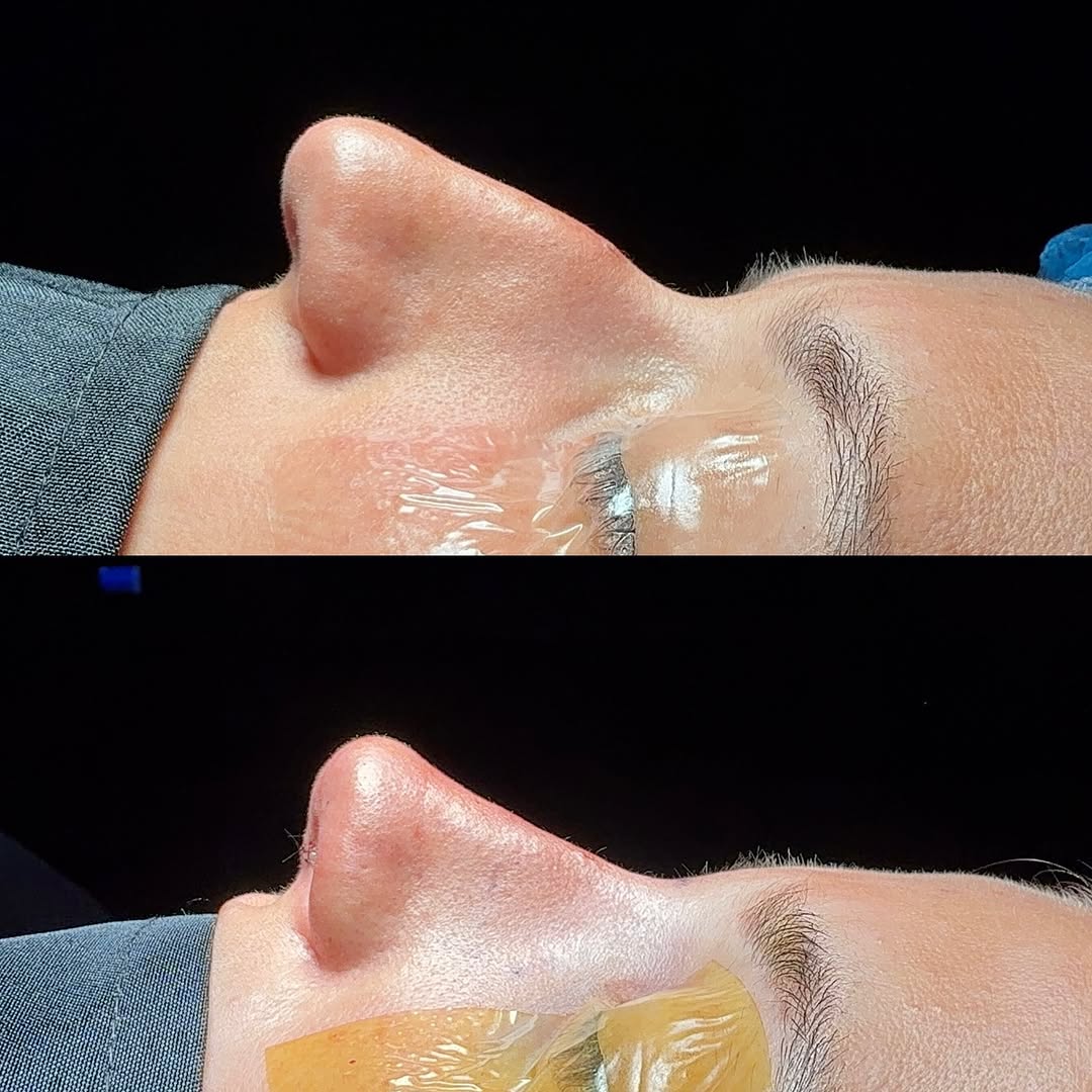 Instagram post by Dr. Julie Shtraks: These rhinoplasty results lately 😮💨
