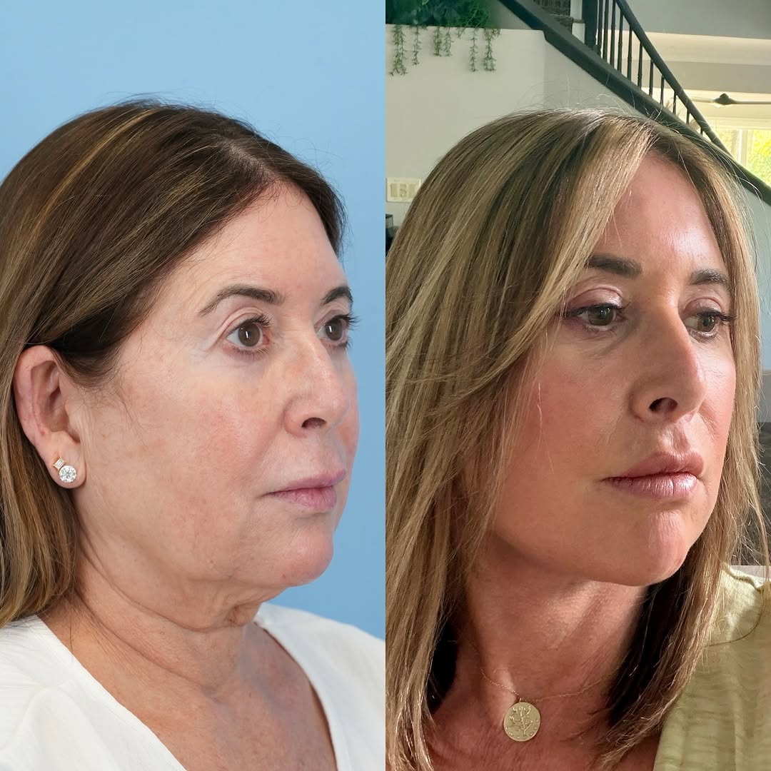 Instagram post by Dr. Julie Shtraks: I was so happy to receive these pictures from my amazing patient who is just 2 months out from her deep plane face & neck lift, upper blepha…