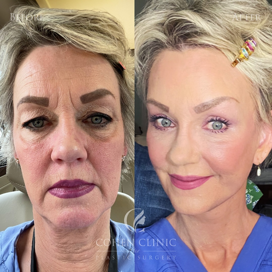 Instagram post by Dr. Justin C. Cohen: Ridiculously in love with these #selfies from my beautiful patient just 4 WEEKS 🤯 out from her facial rejuvenation procedure! She’s healing…