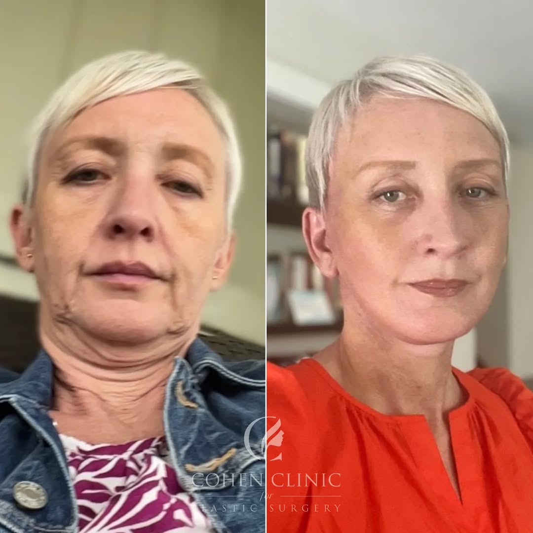 Instagram post by Dr. Justin C. Cohen: Just 9 DAYS out from surgery I had my breath taken away when my beautiful patient sent me these before&after selfies! 😲 . She had previousl…