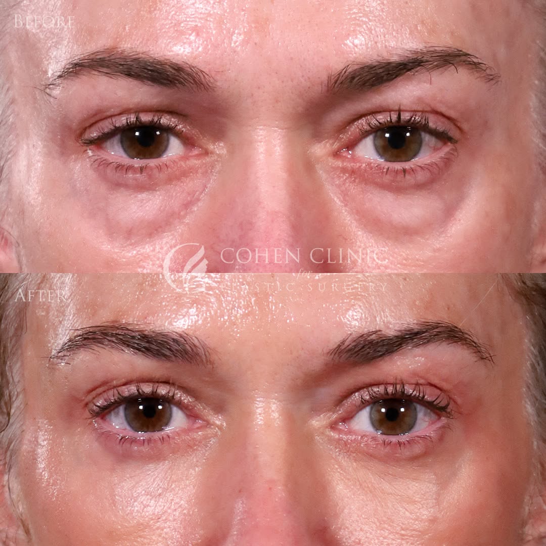 Instagram post by Dr. Justin C. Cohen: The eyes have it. 😉 Subtle. Natural. I'm in love. 📧 info@cohenclinicDC.com 📱(703) 349-7803