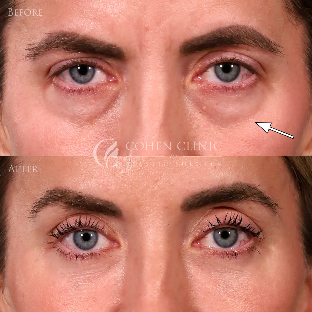Instagram post by Dr. Justin C. Cohen: This beautiful patient felt like she always looked tired, no matter how much rest she got the night before. So to give her a subtle refresh …