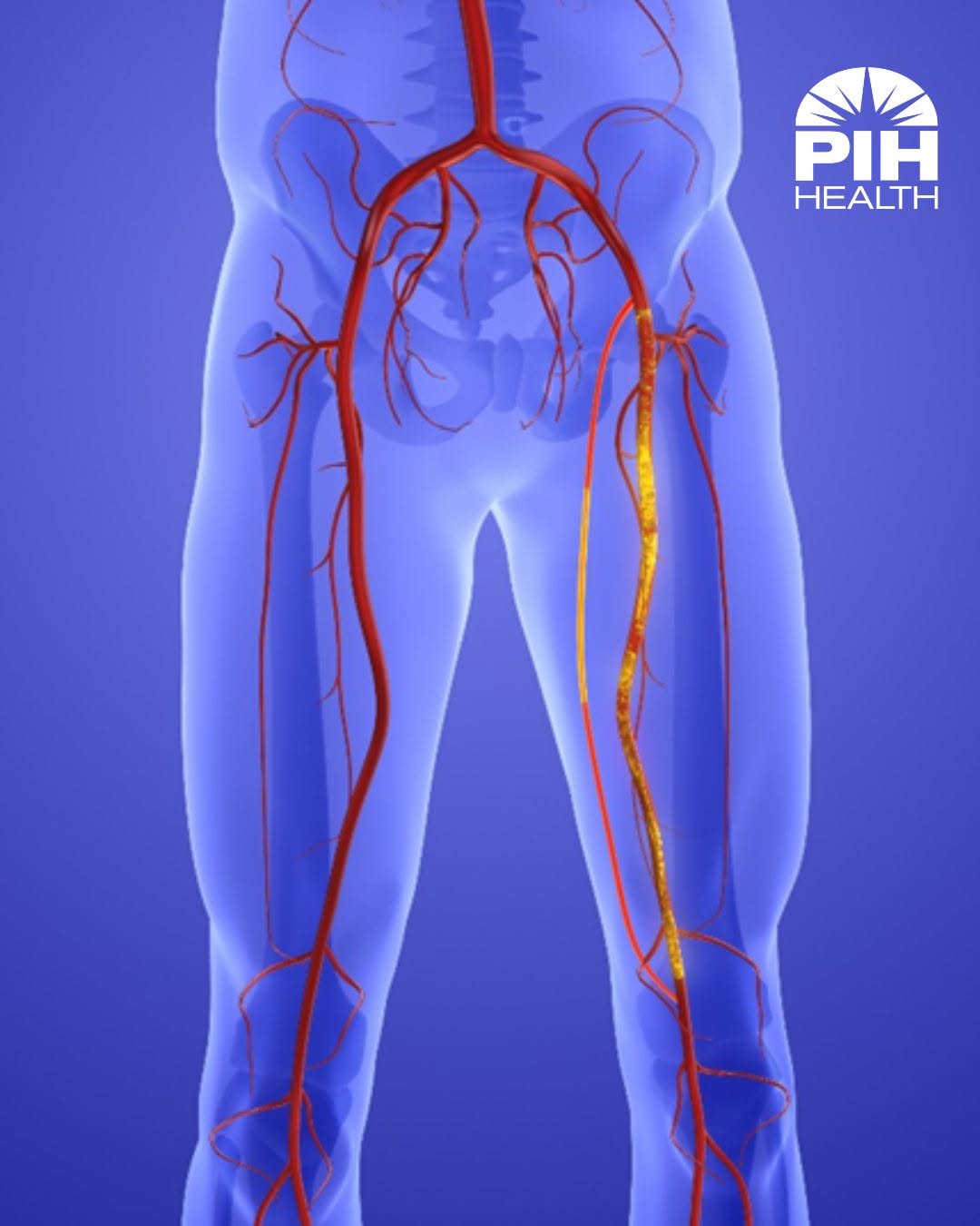 Instagram post by Dr. Justin D. Braverman: Have you heard of peripheral artery disease (PAD)? PAD is a common condition that reduces blood flow to your legs and feet due to plaque bui…