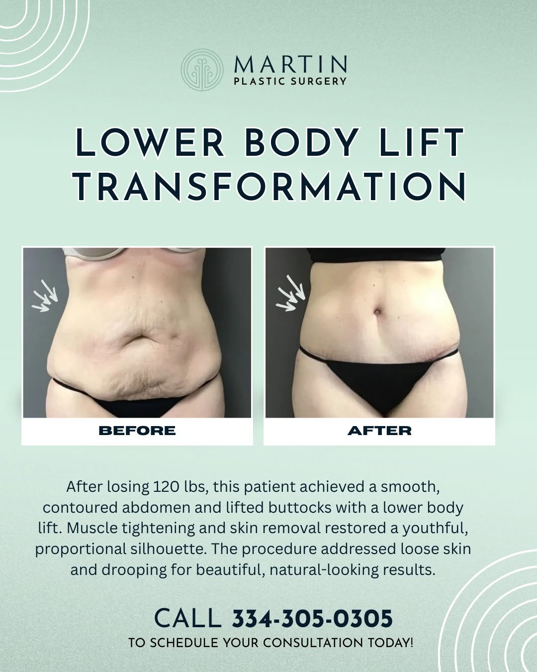 Instagram post by Dr. Justin P. Martin: This 47-year-old woman from Destin, Florida achieved an incredible transformation with a lower body lift after losing 120 lbs. ✨ ㅤ After her…