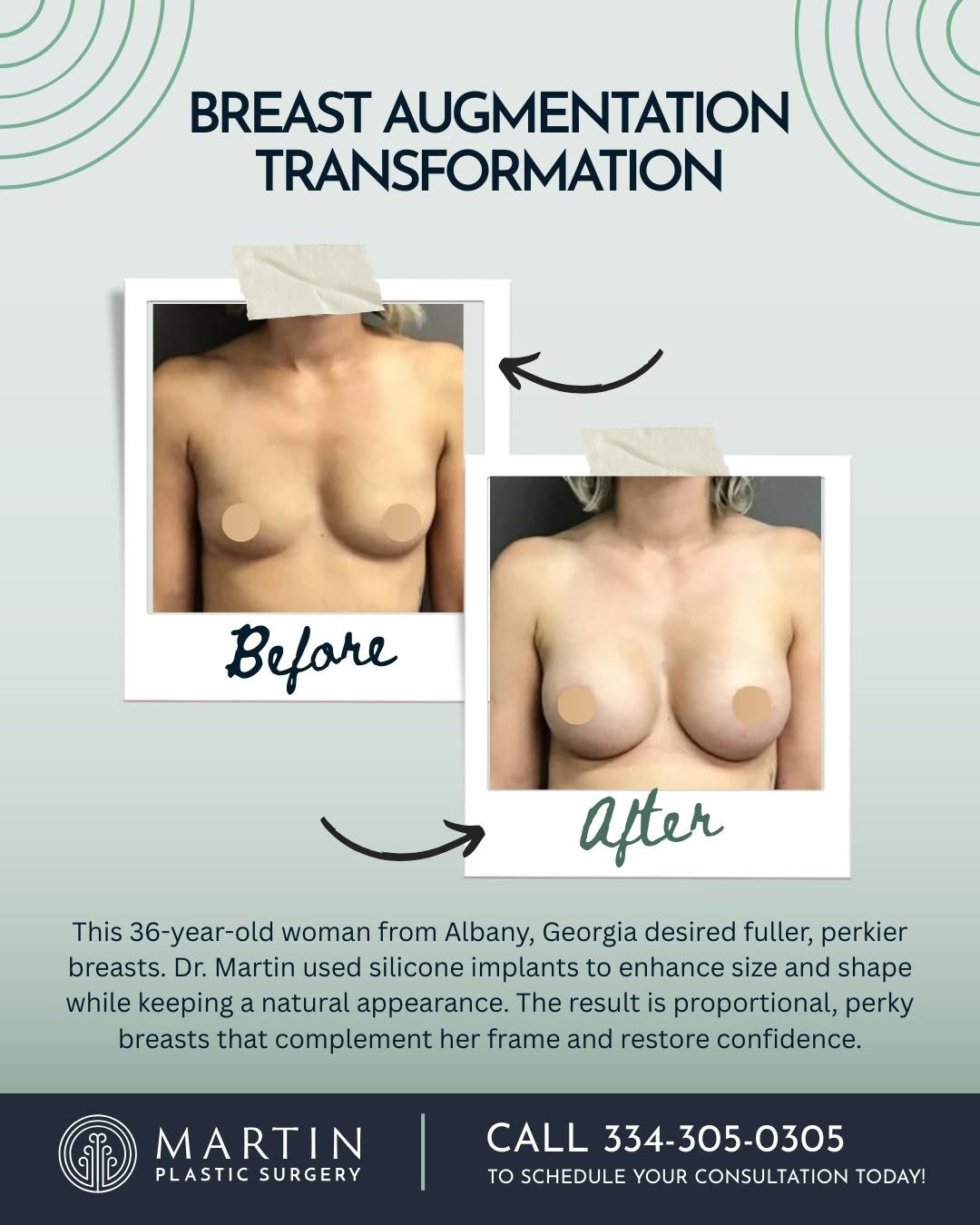 Instagram post by Dr. Justin P. Martin: This 36-year-old woman from Albany, Georgia wanted fuller, perkier breasts that felt natural and proportionate to her frame. 💖 With silicon…