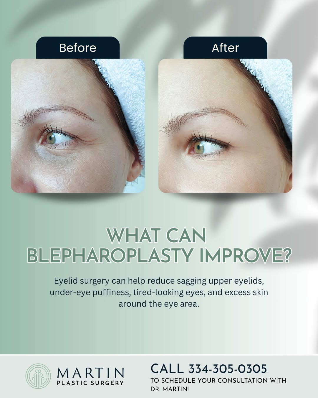 Instagram post by Dr. Justin P. Martin: Tired-looking eyes can sometimes make you look older or more fatigued than you feel. ✨ Eyelid surgery, also known as blepharoplasty, can hel…